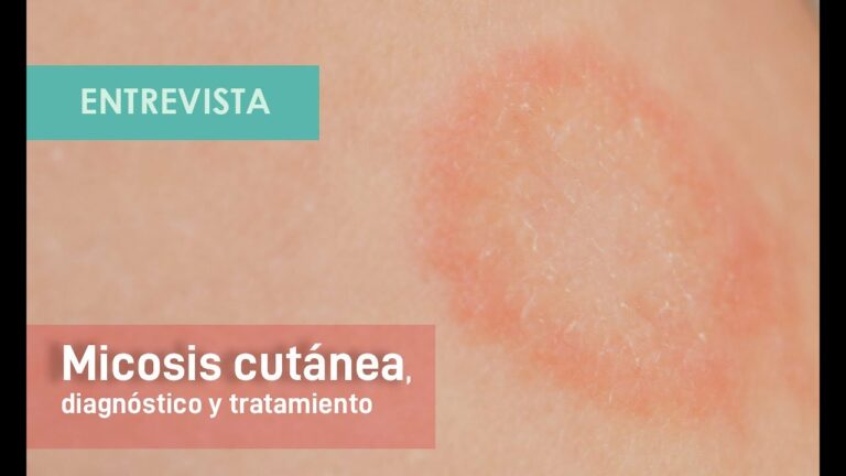 Infecciones Bacterianas y F&uacute;ngicas en la Piel Infantil: Prevenci&oacute;n y Tratamiento