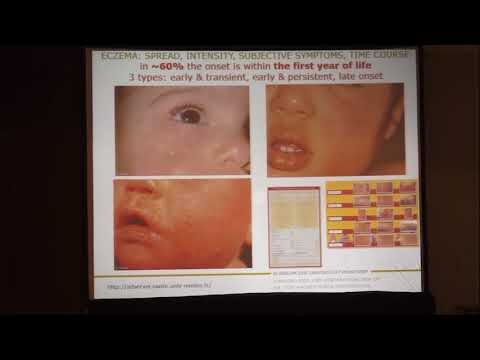 Prevenci&oacute;n de alergias: La lactancia materna como clave